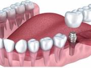 Dental Implants 30290 - Tyrone Family Dentistry