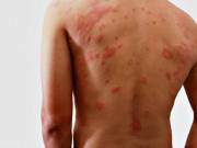 Scabies Over The Counter Cream