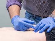 Heal Muscle & Ligaments Injuries With Dry Needling 