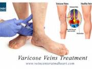  Varicose Veins Treatment