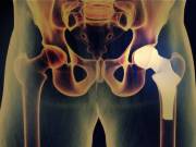Consult a Specialist for Minimally Invasive Hip Replacement in Plano, TX