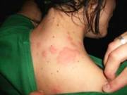 Bed Bugs San Mateo CA, Bed Bug Exterminator San Mateo CA, Bed Bug Control San Mateo CA,