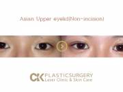 Asian Blepharoplasty in Orange County