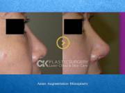 Asian Nose Surgeon Orange County