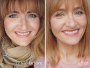 Laser Teeth Whitening Dentist Dallas 