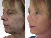 Non-Surgical Facelift Treatment by Lip Doctor