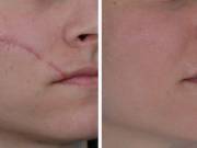 Non-Surgical Scar Treatment - Lip Doctor