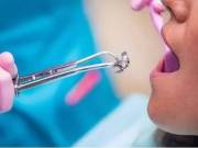 Dental Services: Root Canal Treatment in Thousand Oaks, CA