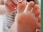 Warts On Feet Treatment Elizabeth